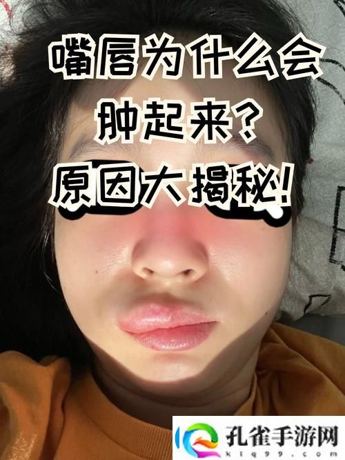 为什么上下两张嘴都肿了