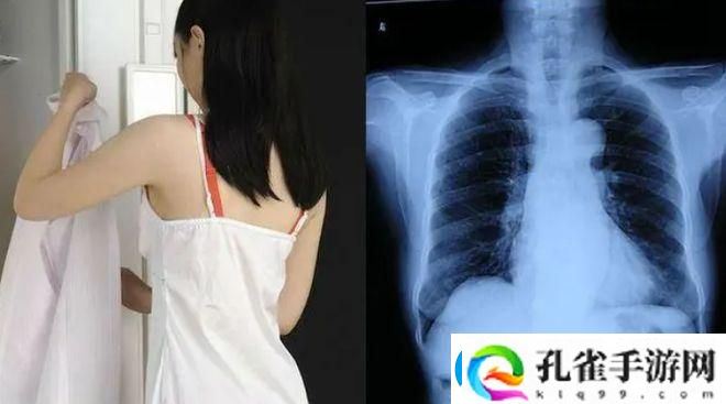100%胸片曝光率图片女生